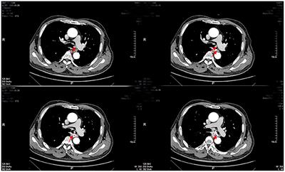 Endobronchial Metastasis of Renal Carcinoma: A Case Report and Review of Previous Literature